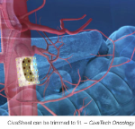 Graphic of medical implant on the pancreas